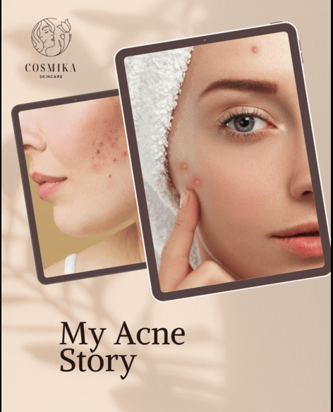 Acne & Scar Removal